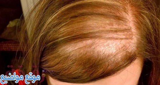 زراعة الشعر للنساء في تركيا بالأسعار والتكلفة